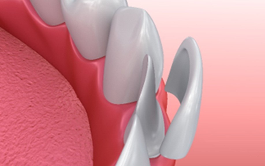 Illustration of dental veneer being placed on tooth